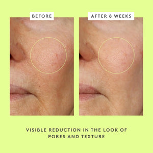 Before and after images showing visible reduction in pores and texture after using Drunk Elephant glycolic night serum for 8 weeks
