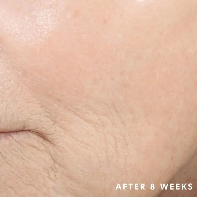 Close up of facial skin showing improvement after 8 weeks using Skinceuticals Triple Lipid Restore 242 cream