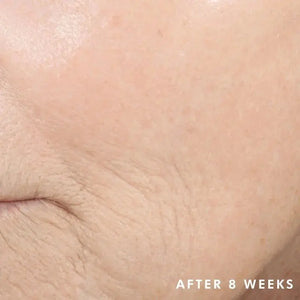 Close up of facial skin showing improvement after 8 weeks using Skinceuticals Triple Lipid Restore 242 cream